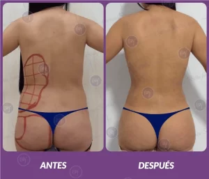Lipotransferencia 8